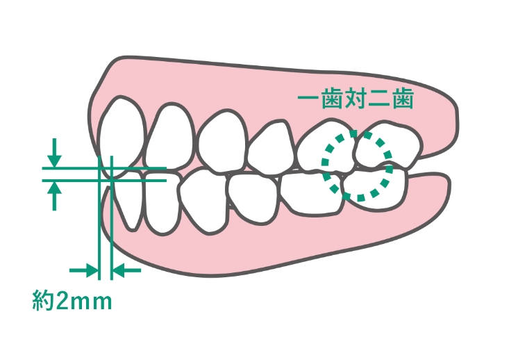 奥歯が咬み合っていない状態