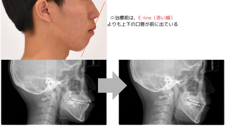 岡山矯正歯科での口ゴボのインビザライン矯正の抜歯症例