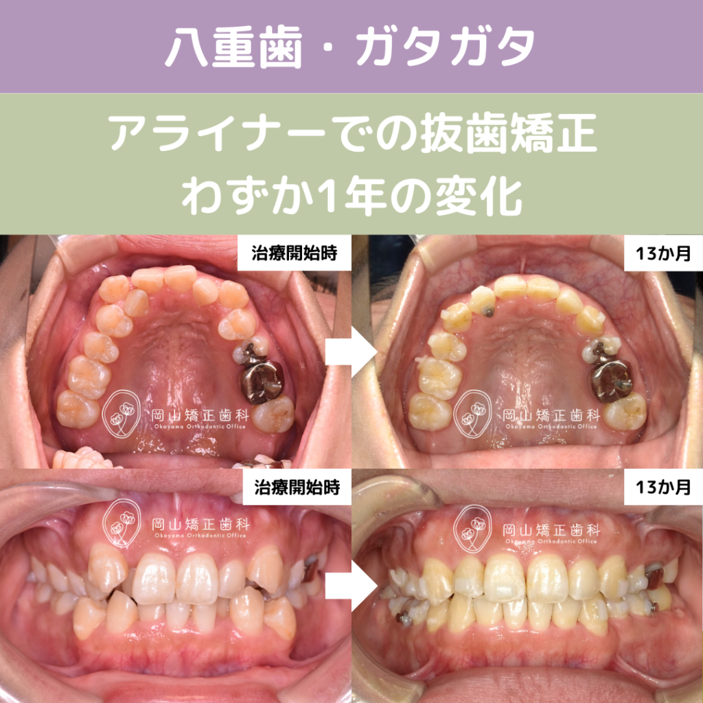 当院院長によるマウスピース矯正治療の治療前後の写真