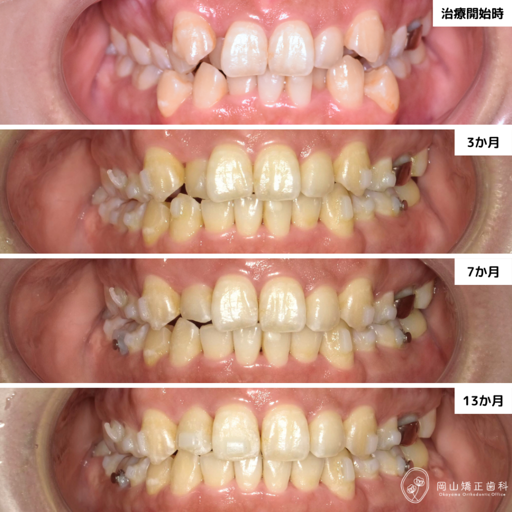 先程の院長による治療の経過写真です。短期間で八重歯が改善されたことがお分かりになると思います。