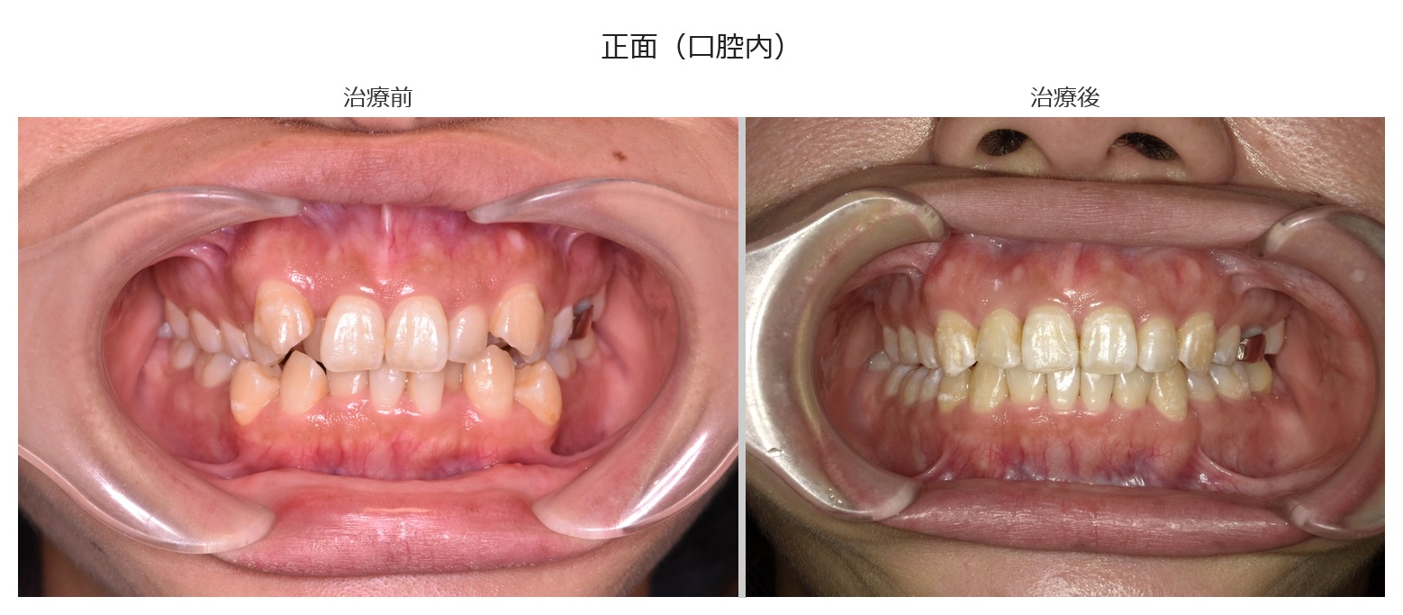 治療前後 正面