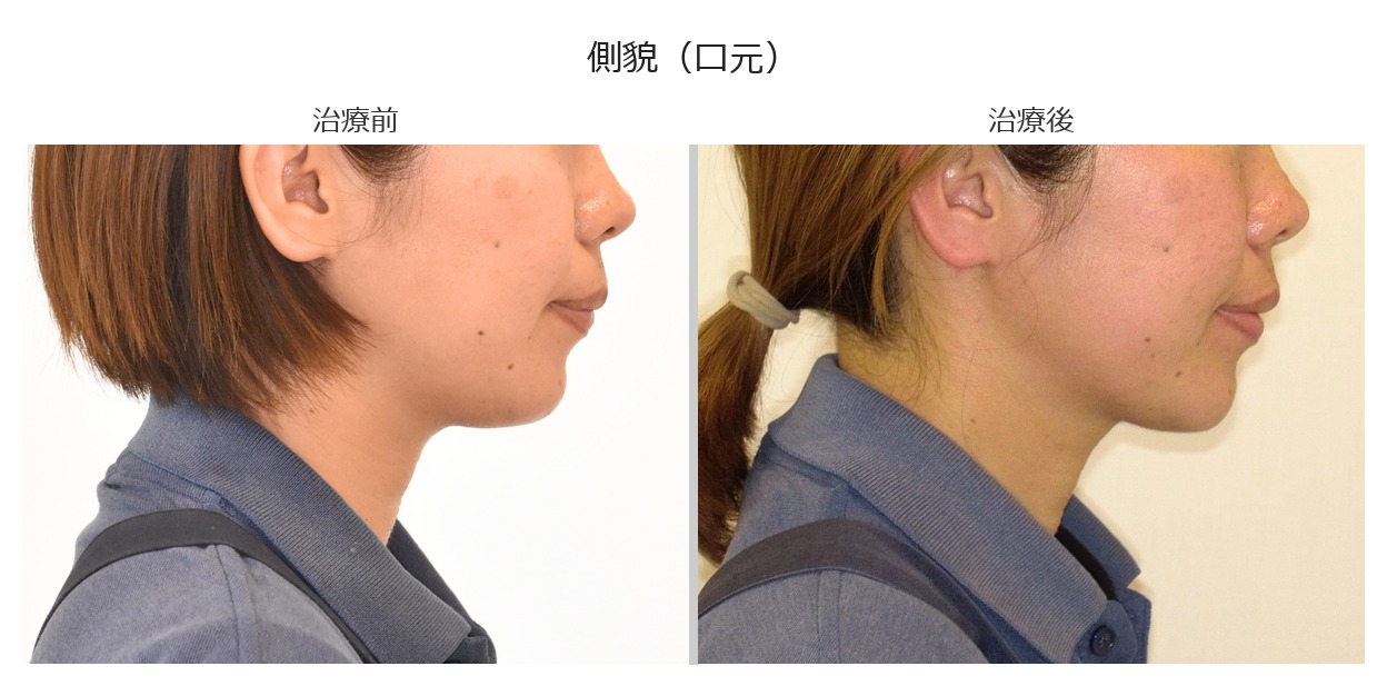 治療前後 側貌