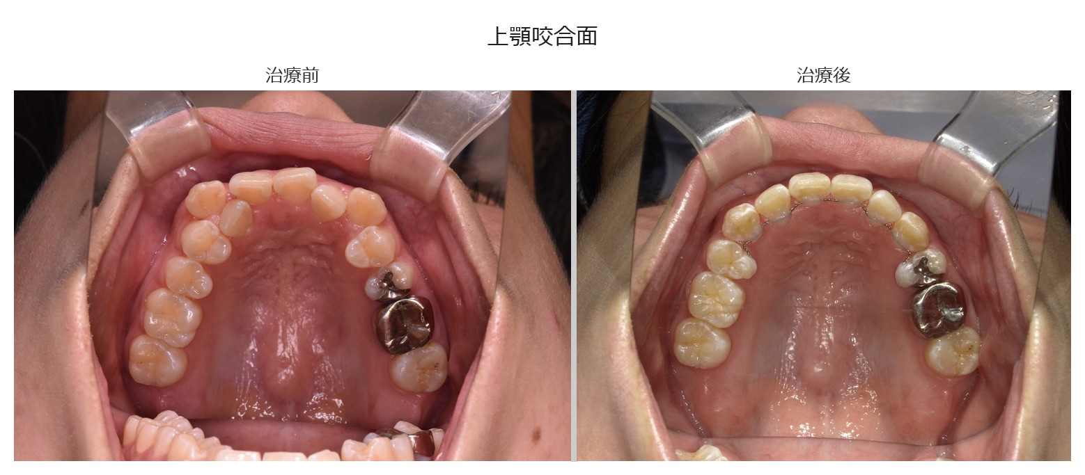 治療前後 上顎咬合面