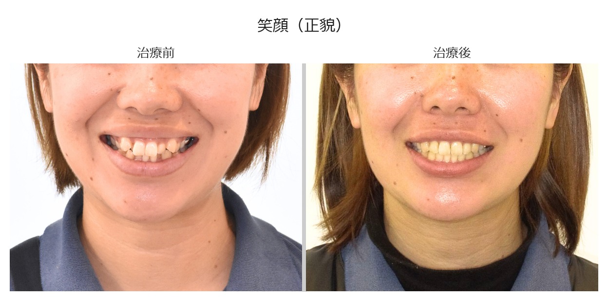 治療前後 笑顔