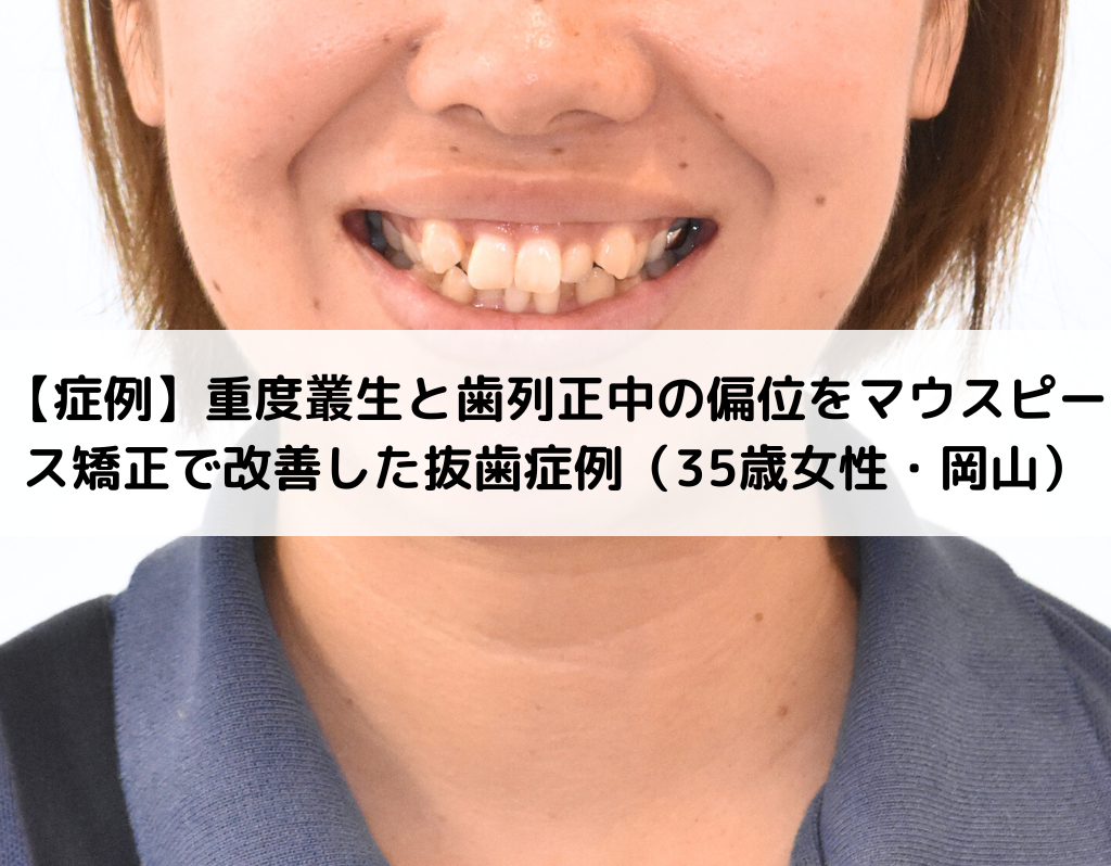 【症例】重度叢生と歯列正中の偏位をマウスピース矯正で改善した抜歯症例（35歳女性・岡山）